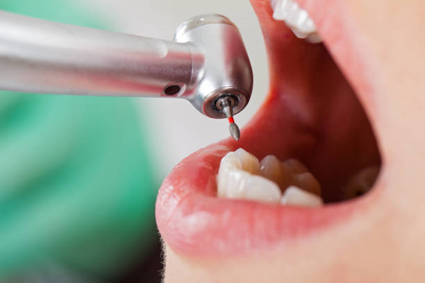 Best Emergency Cosmetic Dentistry in Meron Park, CA